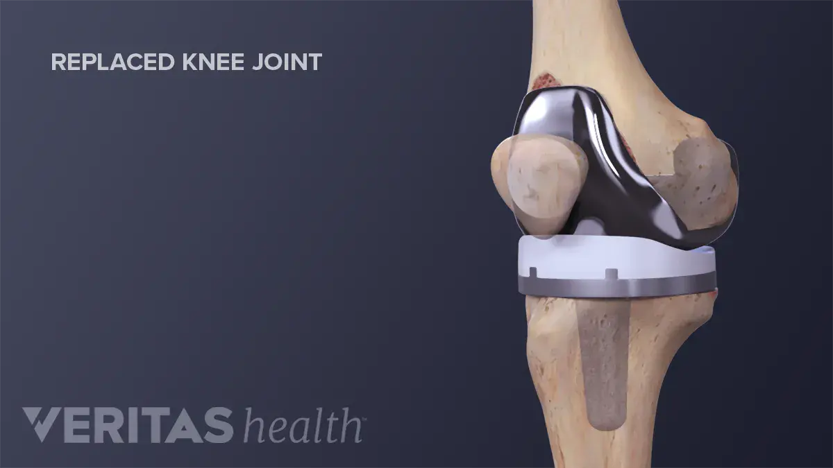 Knee to be replaced?