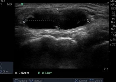 Knee ultrasound &#8211; the course of the examination. When to do a knee ultrasound?