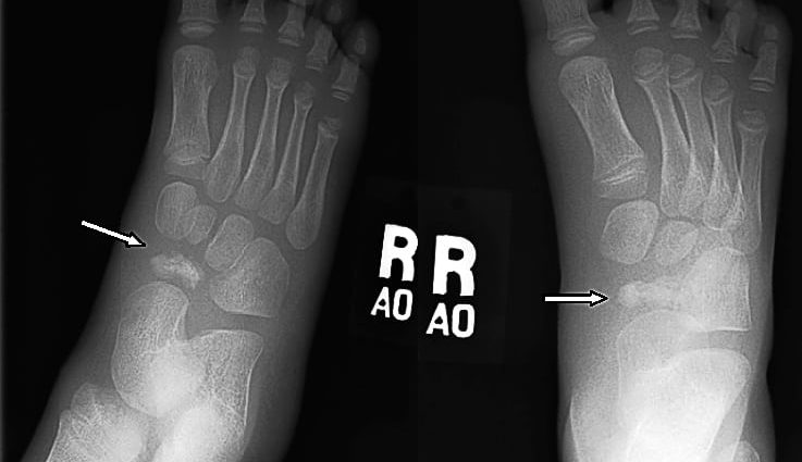 Kohler&#8217;s disease &#8211; causes and symptoms. How To Treat Aseptic Bone Necrosis?