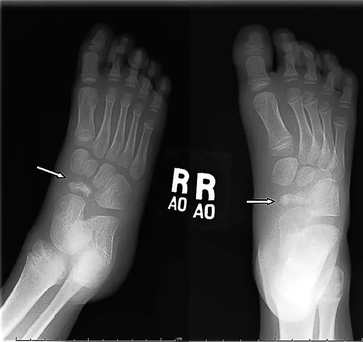 Kohler&#8217;s disease &#8211; causes and symptoms. How To Treat Aseptic Bone Necrosis?