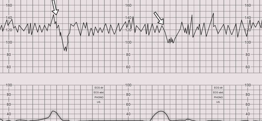 KTG &#8211; test for pregnant women. When to perform a CTG?