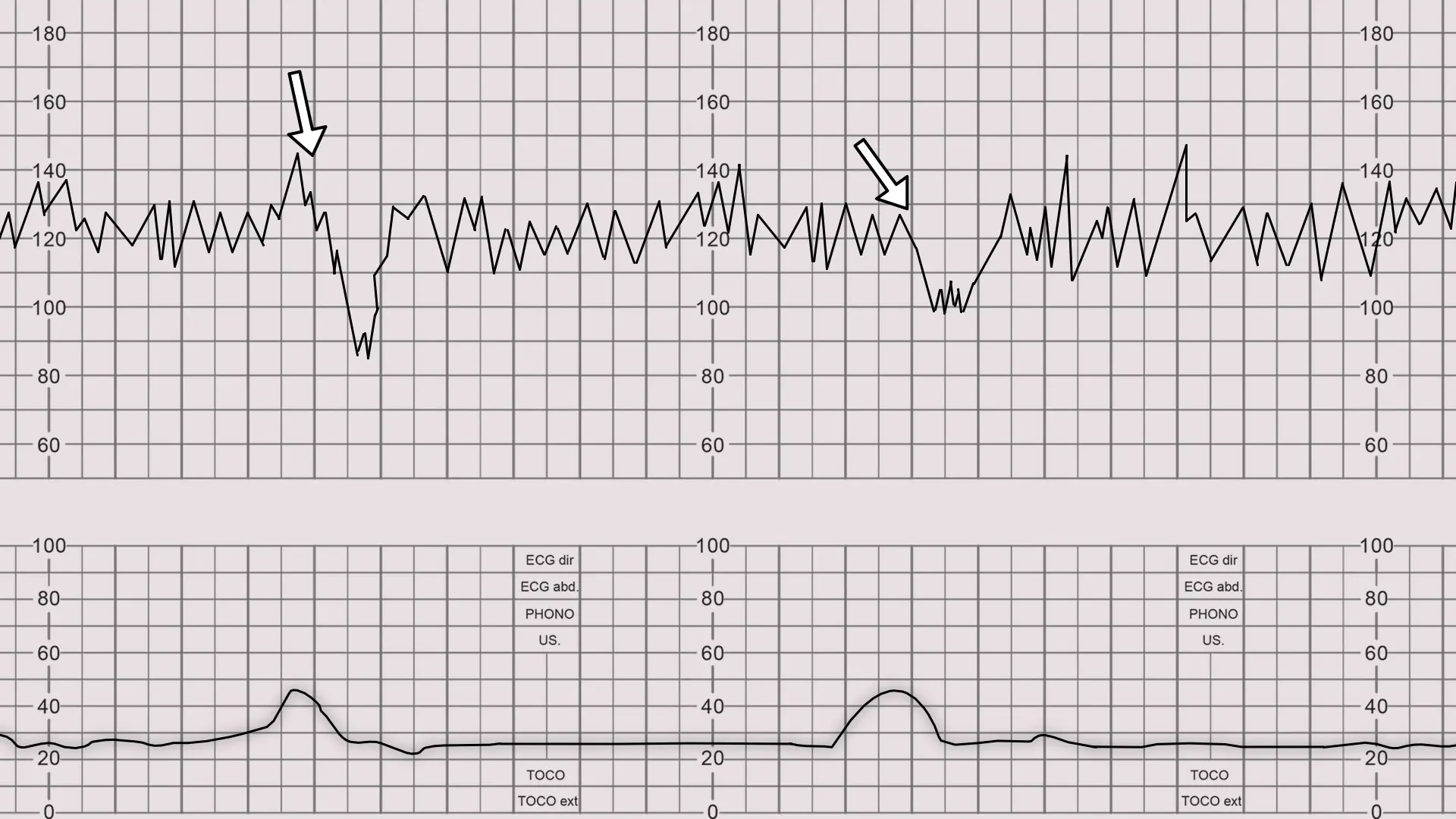 KTG &#8211; test for pregnant women. When to perform a CTG?