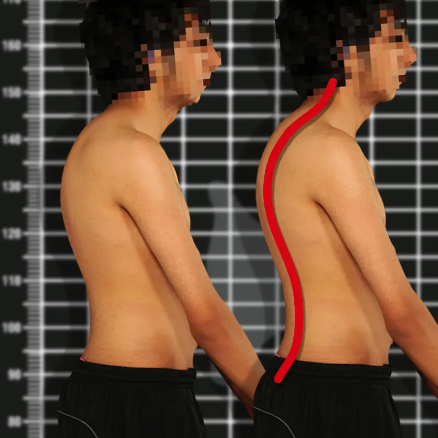 Kyphosis, that is, a round back. What is worth knowing about it?