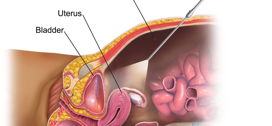 Laparoscopy &#8211; what is this procedure