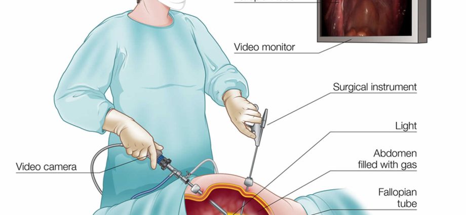 Laparotomy &#8211; course, preparation, possible complications. When should you decide on the procedure?