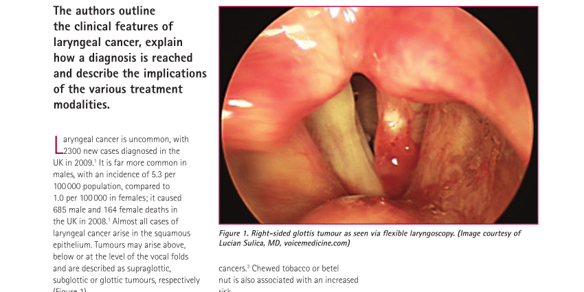 Laryngeal cancer &#8211; cancer of the &#8220;real&#8221; man