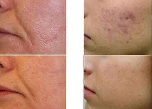 Laser scar removal