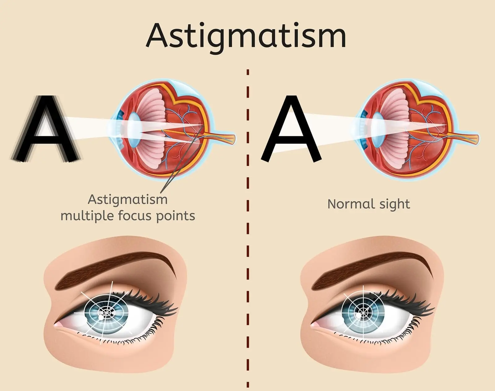 Laser vision correction and astigmatism