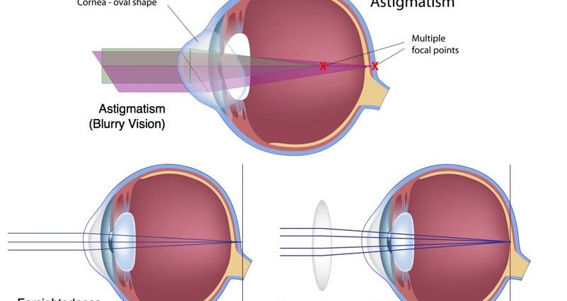 Laser vision correction and hyperopia