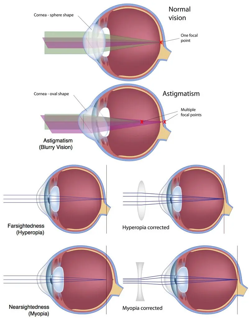 Laser vision correction and hyperopia