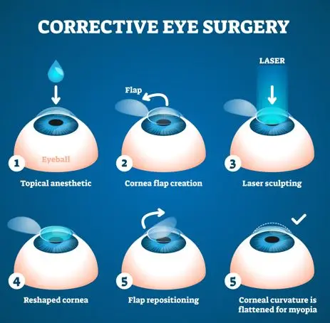 Laser vision correction in children