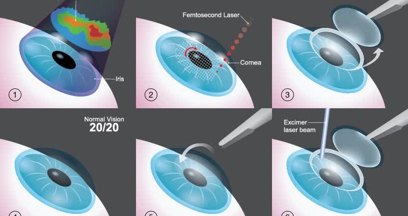 Laser vision correction using the femtoLASIK method. Course, recommendations and side effects