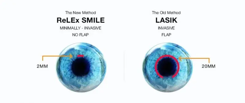 Laser vision correction using the ReLEx smile method