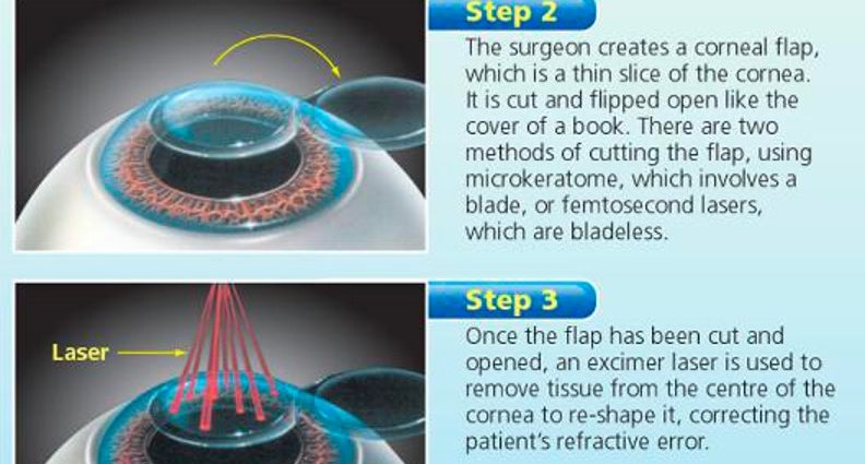 LASIK method. Qualification, course and side effects