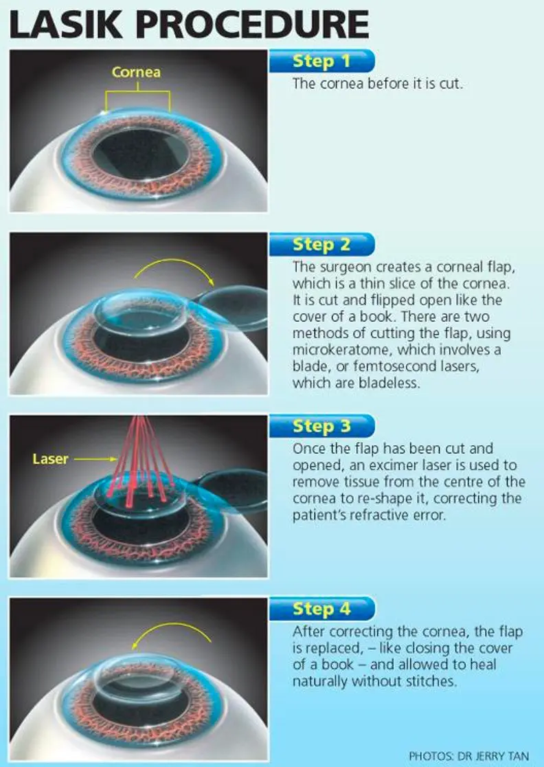 LASIK method. Qualification, course and side effects