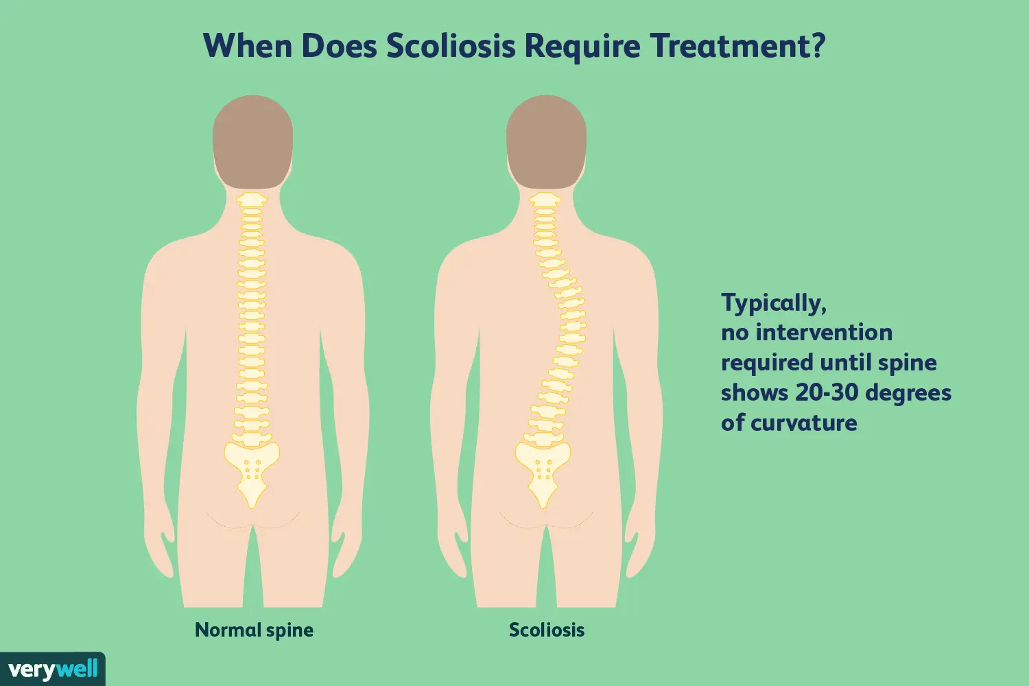 Lateral curvature of the spine