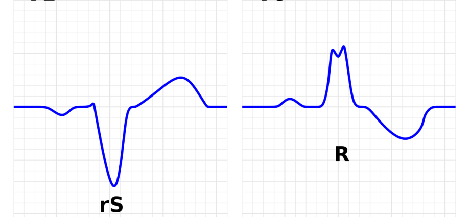 Left bundle branch block