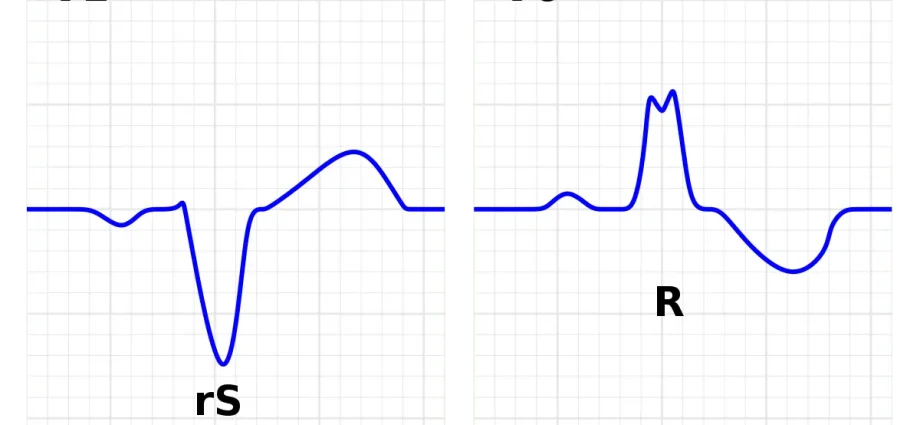 Left bundle branch block