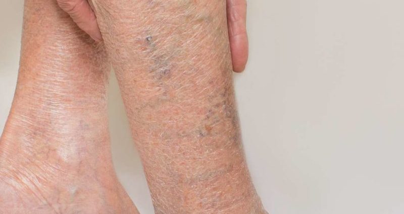 Legs without varicose veins