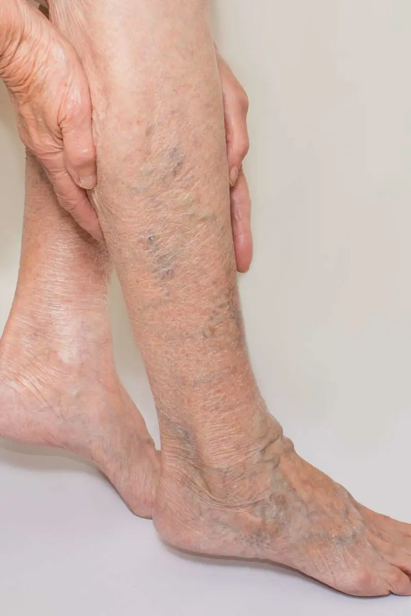 Legs without varicose veins