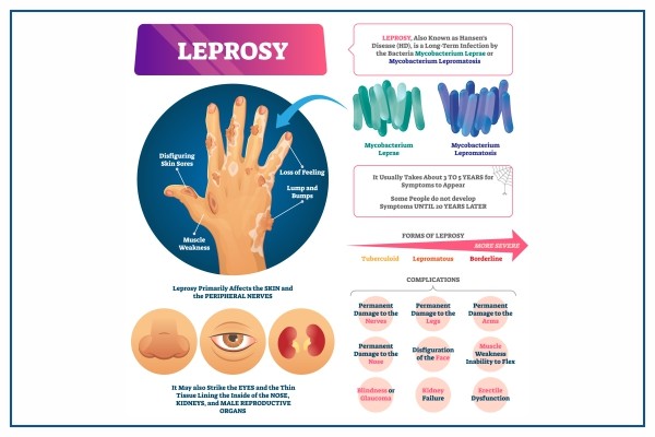 Leprosy &#8211; Symptoms and Treatment. How can you get infected?