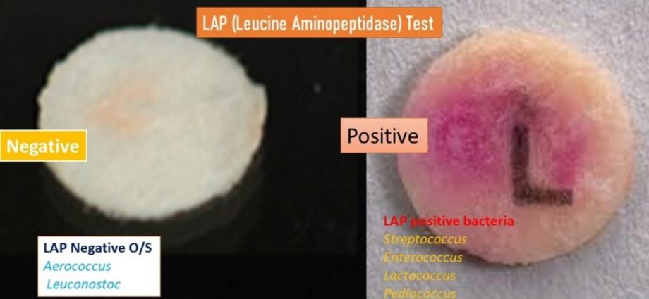 Leucine aminopeptidase (LAP) &#8211; when to test, possible complications