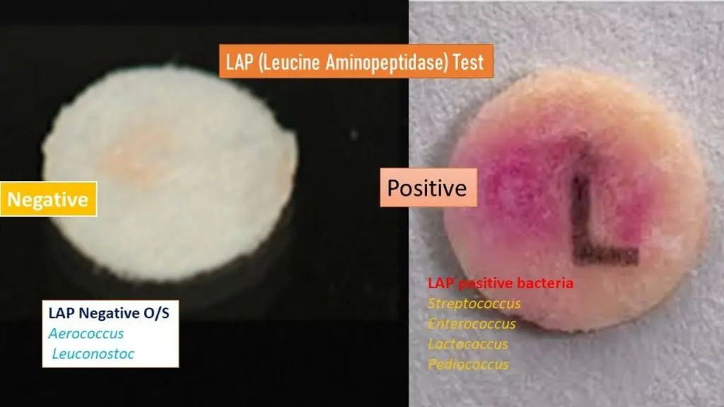 Leucine aminopeptidase (LAP) &#8211; when to test, possible complications