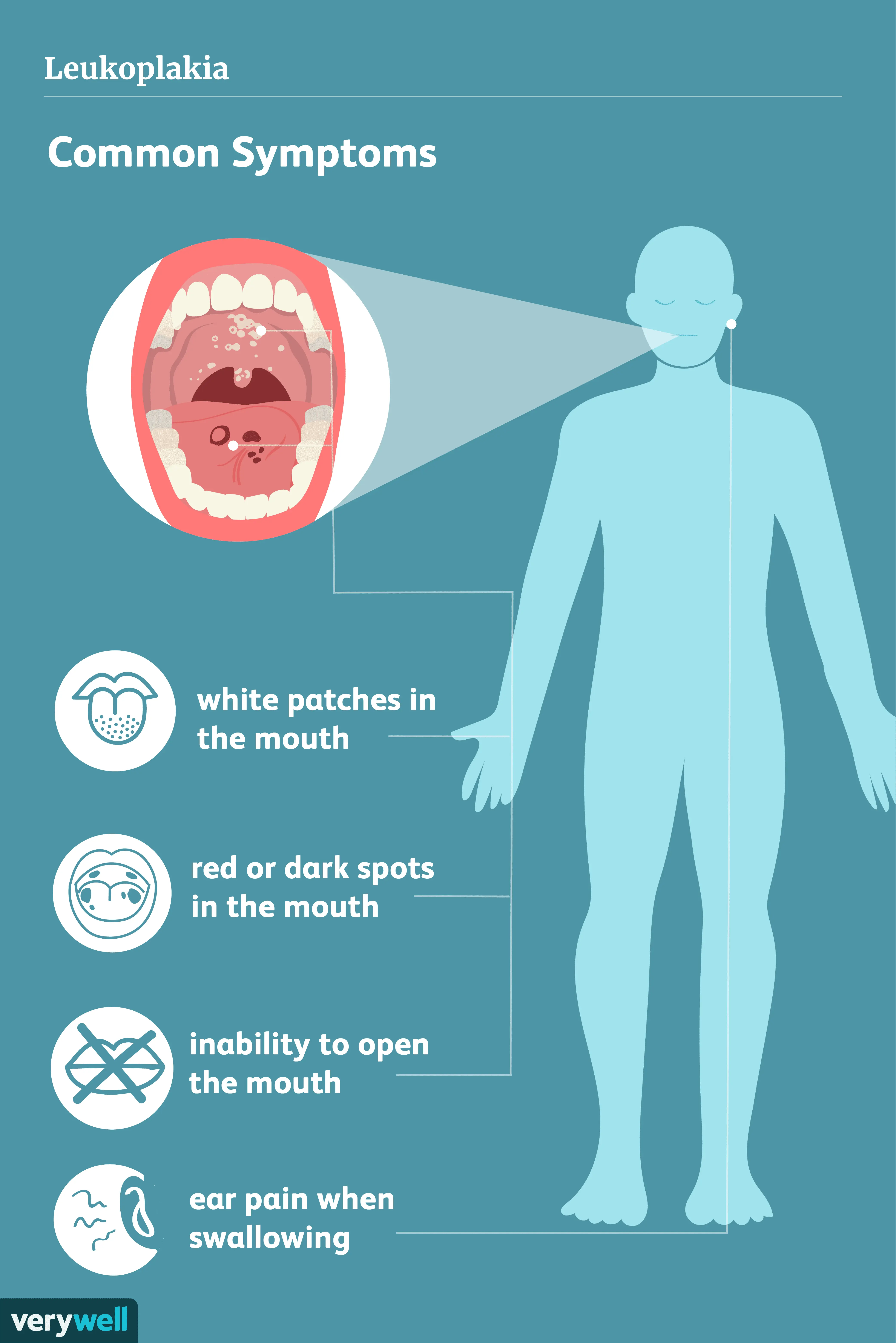 Leukoplakia &#8211; symptoms, causes, types, treatment