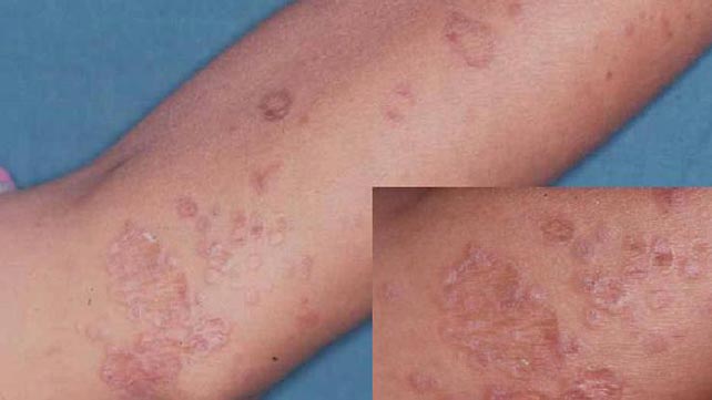 Lichen planus &#8211; causes, symptoms, photos, treatment