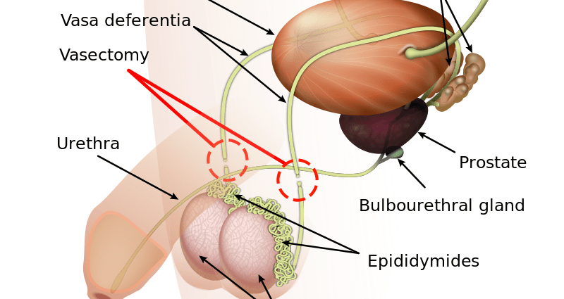 Ligation of the vas deferens