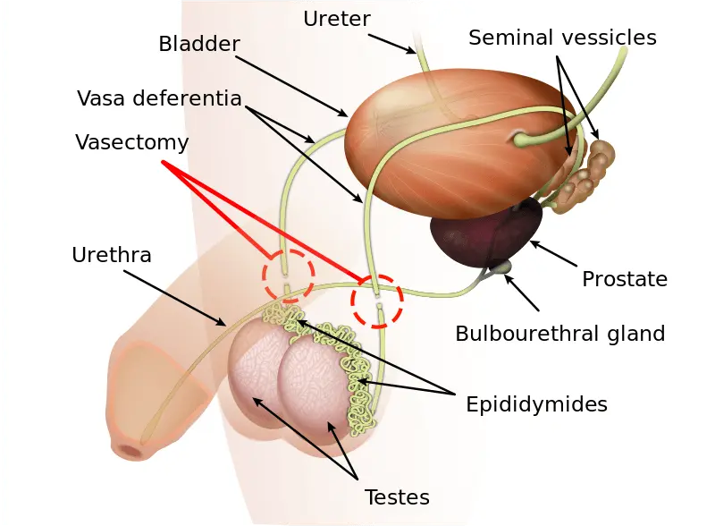 Ligation of the vas deferens