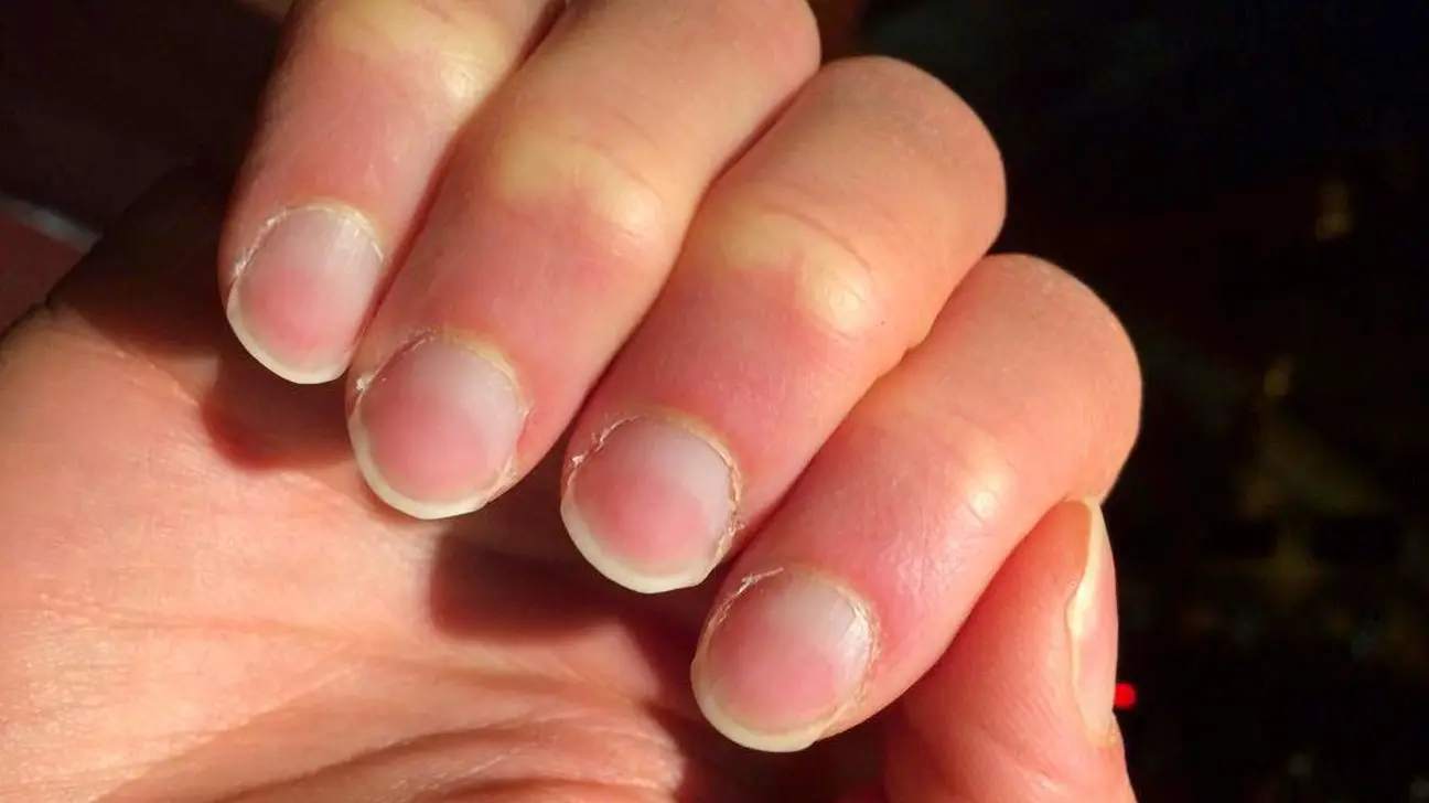 Lindsay&#8217;s nails &#8211; how to recognize them and what do they say about your health?