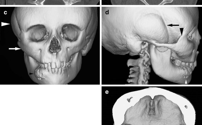 Lion&#8217;s face &#8211; symptoms, differentiation, treatment. What is Cranio-Molar Dysplasia?