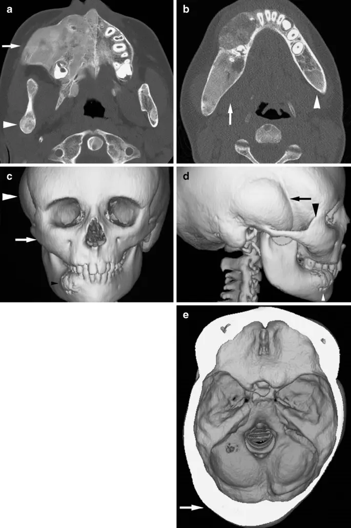 Lion&#8217;s face &#8211; symptoms, differentiation, treatment. What is Cranio-Molar Dysplasia?