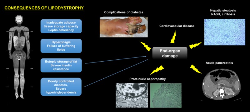 Lipoatrophy &#8211; the main symptoms. What is the characteristic of thinning or loss of adipose tissue?