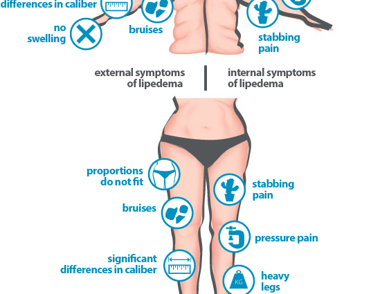 Lipoedema (fatty edema) &#8211; description, symptoms, treatment