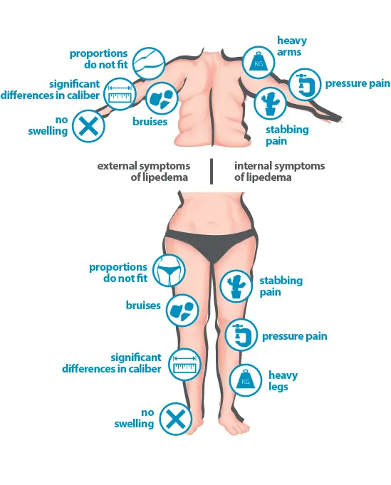 Lipoedema (fatty edema) &#8211; description, symptoms, treatment