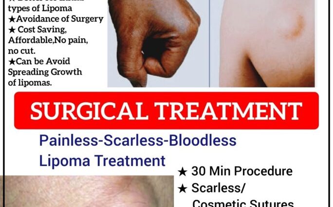 Lipoma &#8211; causes, types. How are lipomas treated?