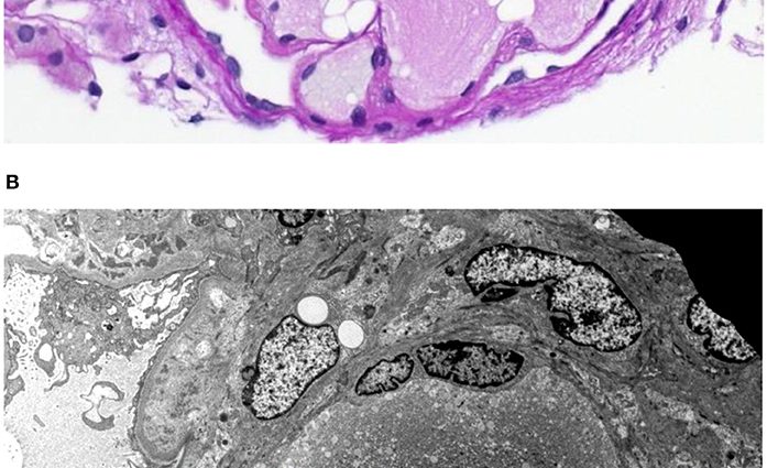 Lipoprotein glomerulopathy &#8211; symptoms and treatment of glomerular disease