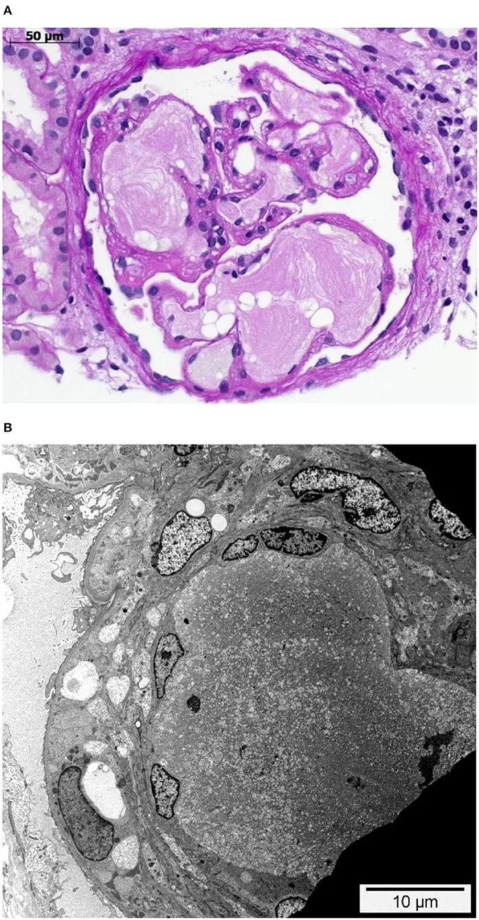 Lipoprotein glomerulopathy &#8211; symptoms and treatment of glomerular disease