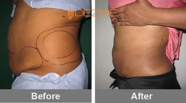 Liposuction does not permanently eliminate adipose tissue