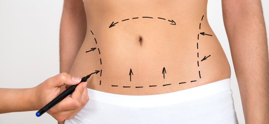 Liposuction &#8211; types, price, indications, contraindications. What is liposuction?