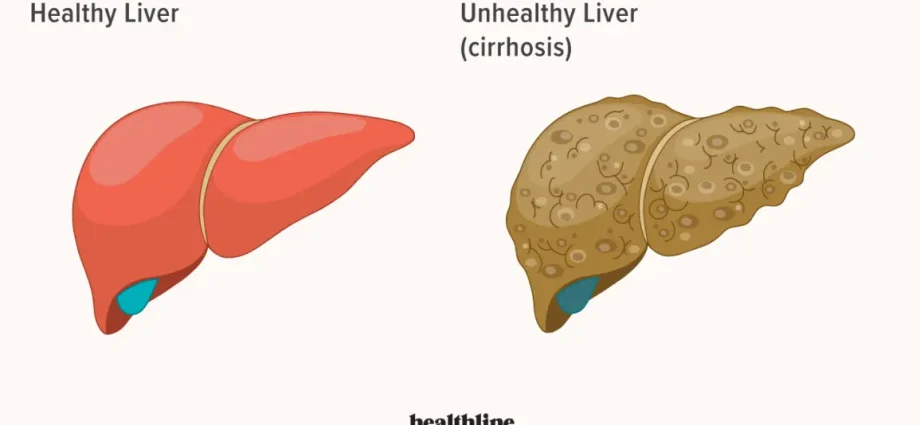 Liver ailments &#8211; what diseases can attack the liver?