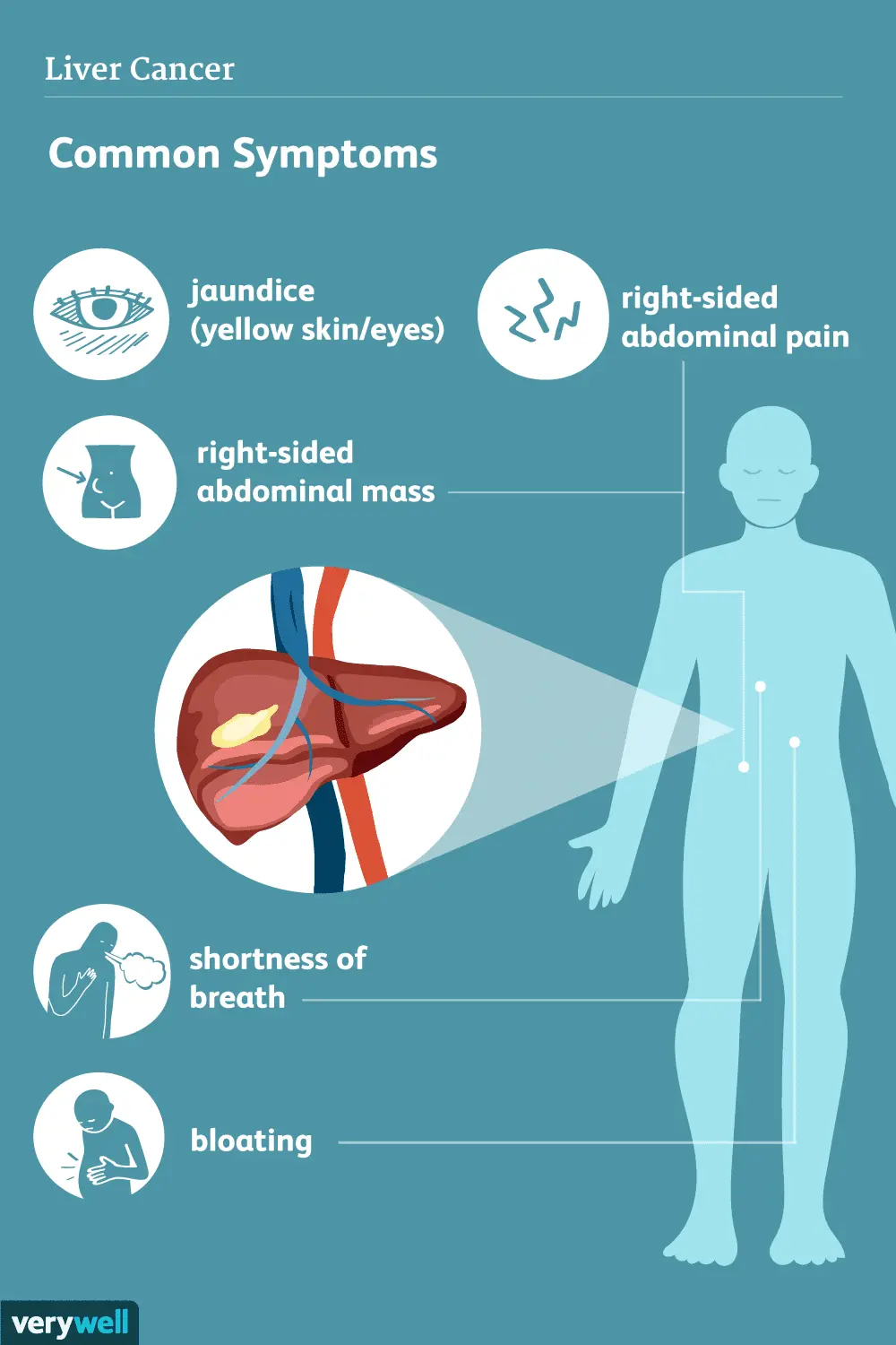 Liver cancer &#8211; symptoms, prognosis, treatment