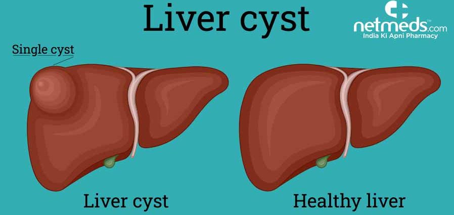 Liver cyst &#8211; causes, symptoms, diagnosis and treatment