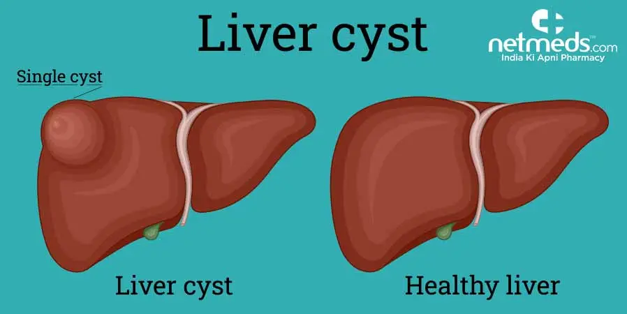 Liver cyst &#8211; causes, symptoms, diagnosis and treatment