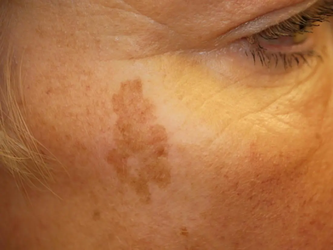 Liver spots &#8211; dark spots on the skin. How to prevent them?