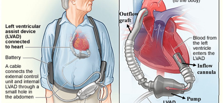 Living with heart failure. What are LVAD?