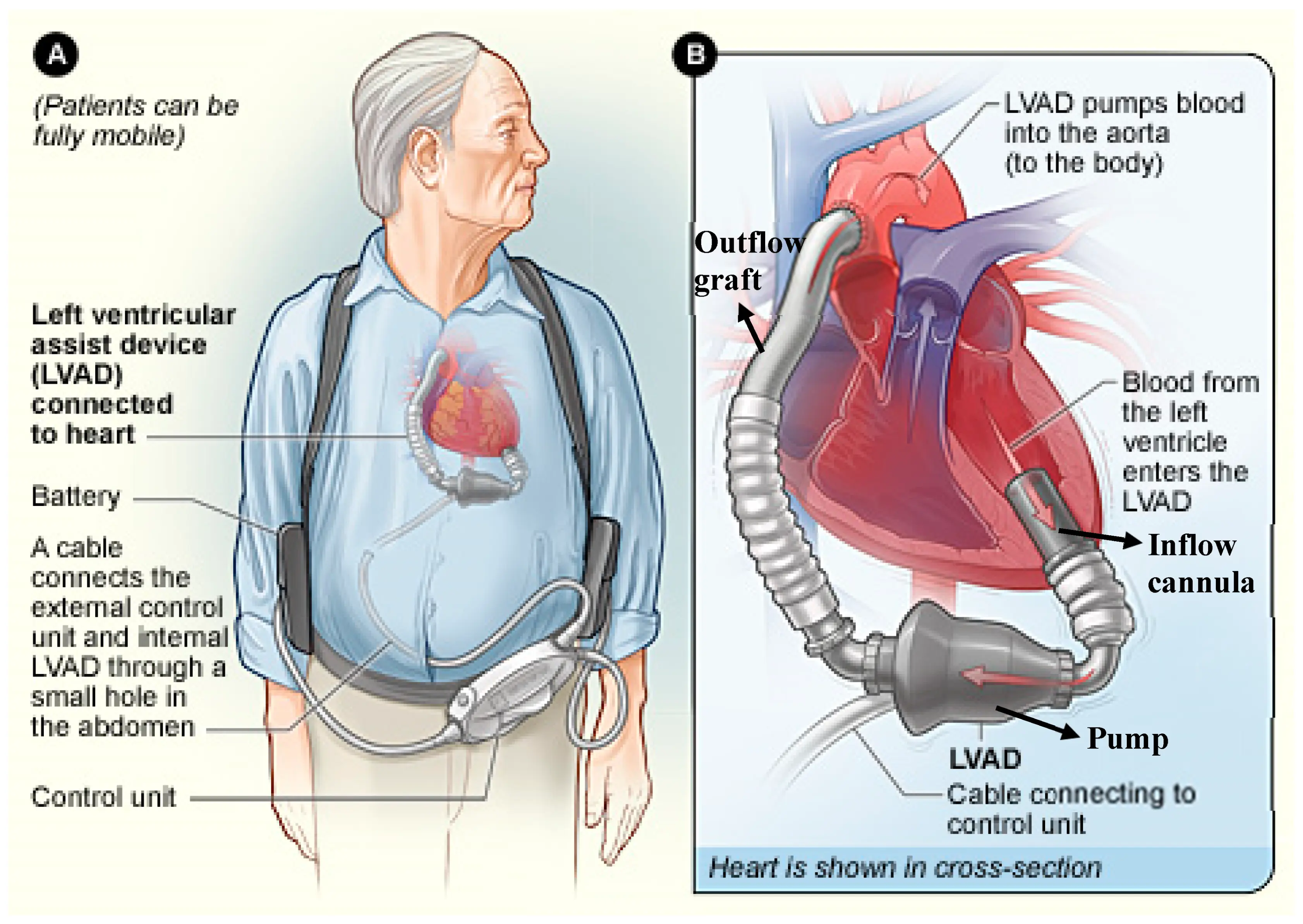 Living with heart failure. What are LVAD?