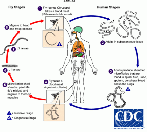 Loaza &#8211; symptoms and treatment. Infection with the Loa loa parasite